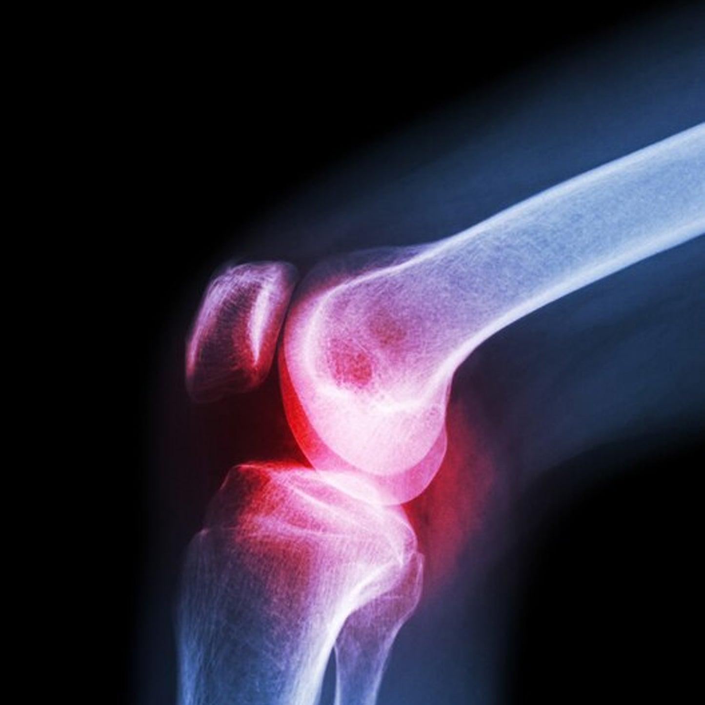 (Xl) Knee Cap For Knee Support